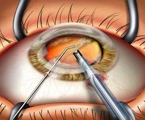 phacoemulsification