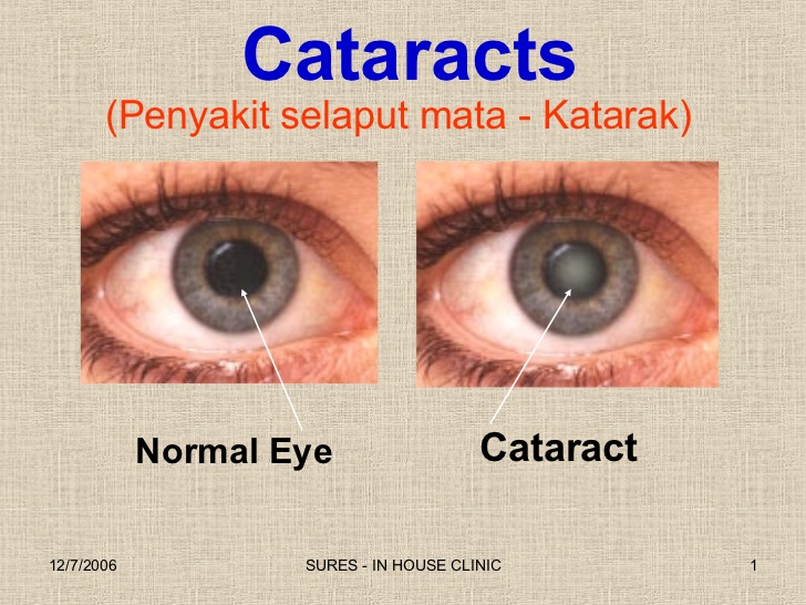 Trio of Doctors to Perform Free Cataract Surgeries for One Day
